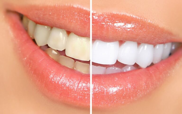 blancamiento dental
